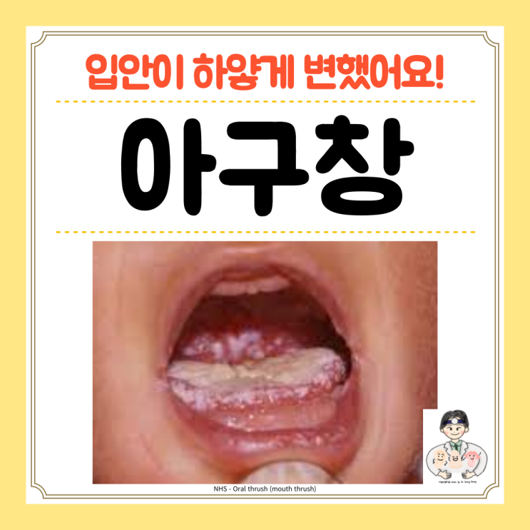  아구창, 구강 칸디다증, 원인 증상 검사 치료 예방
