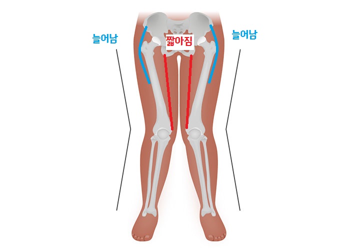  중둔근과 내전근 불균형과 외반슬(X자 다리), 과연 간단한 문제일까?