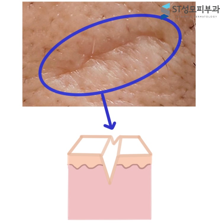  미간 흉터 (패인흉터) 필러 수직당김법, 치료사례 - 삼성동피부과전문의 닥터림