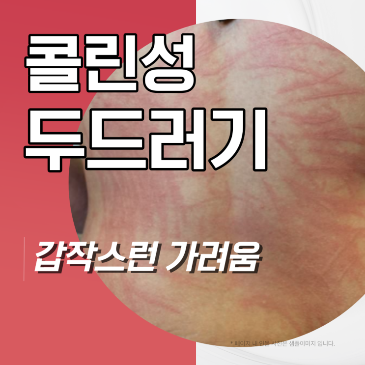  콜린성 두드러기 증상 원인 따가움 가려움