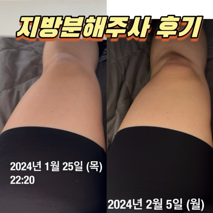  수원지방분해주사 허벅지다이어트로 유명한 이곳! 방문후기