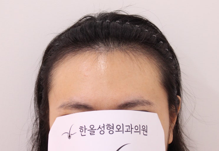  20대 여성 헤어라인 절개 모발이식 3000모