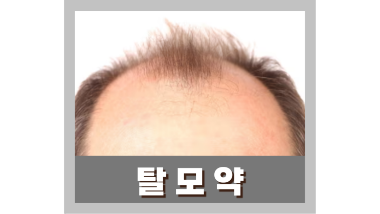  탈모 치료법 탈모약 효과 및 부작용 실비보험 되는지