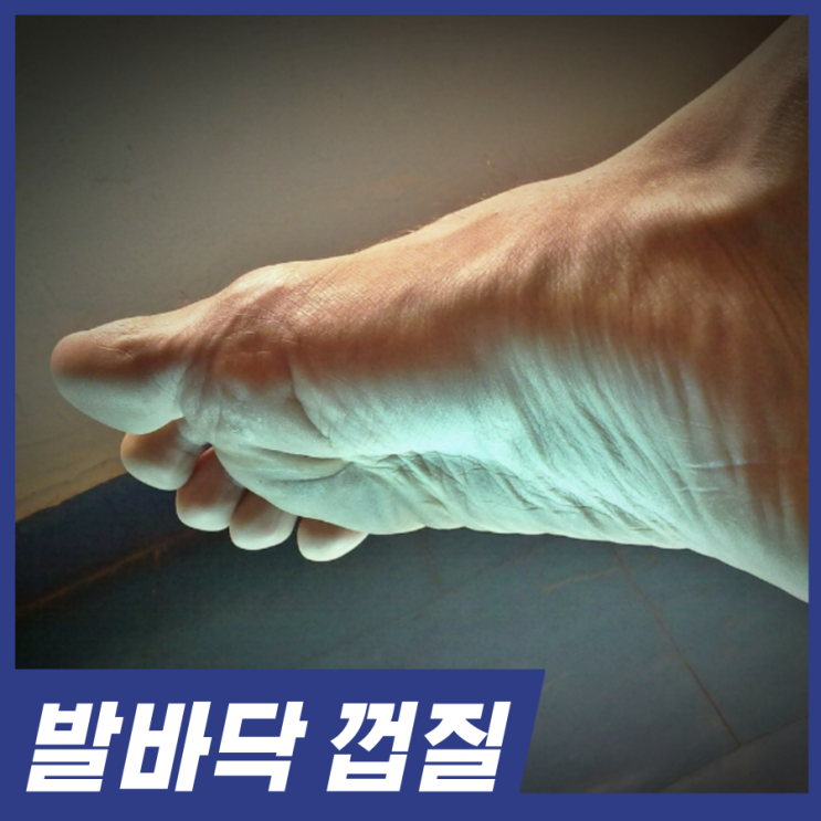  발바닥 껍질 벗겨짐! 원인 4가지와 해결방법 알아보세요.