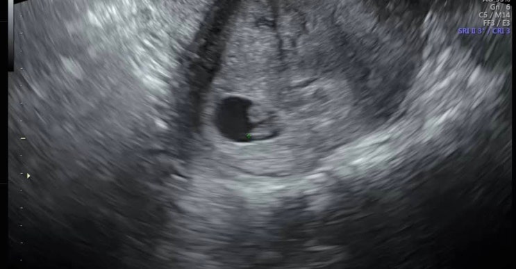 [임신6주] 6주5일/쌍둥이/내가.. 쌍둥이 엄마..?