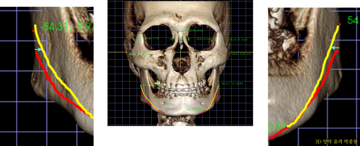 3D CT를 이용한 안면윤곽 사각턱 수술 절제 위치에 따른 얼굴폭 축소량 조절(2) - 남성윤곽 사각턱 절제 높이 정면효과 체지방 안면윤곽수술후붓기