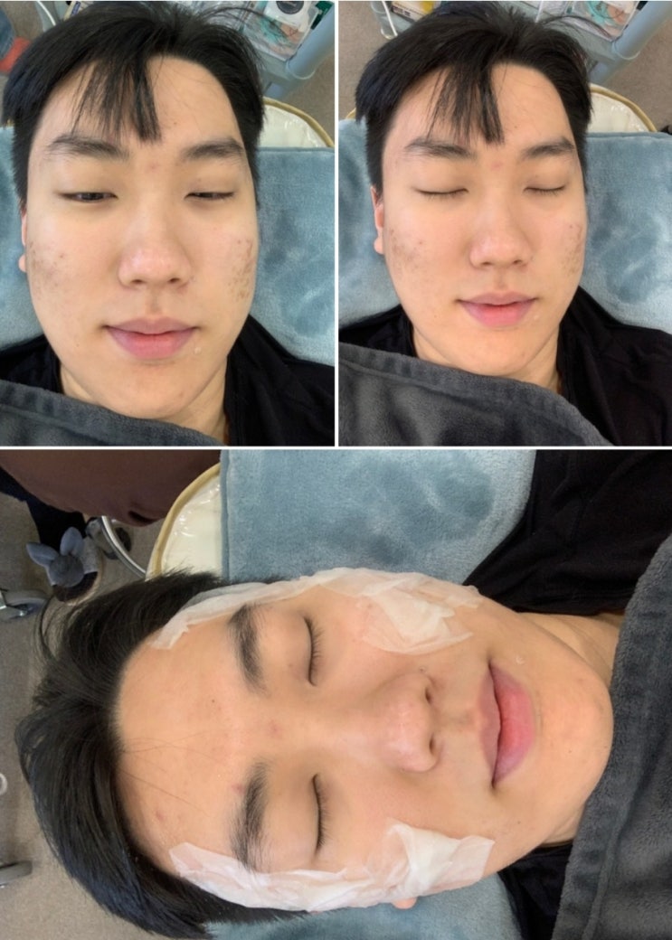  세종시 피부관리 더나인에서 콜드플라즈마 여드름 흉터관리받은 후기