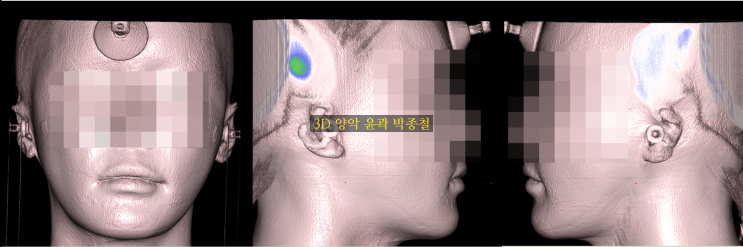 사각턱 복원 재건 3D 안면골 보형물 디자인시 대칭성에 대하여 고려할 사항 (1)