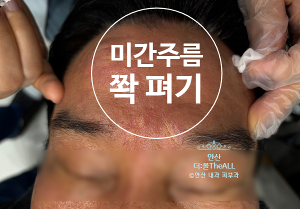  이마미간주름 패치보다 효과적인 주름개선방법 안산 월피동 피부과