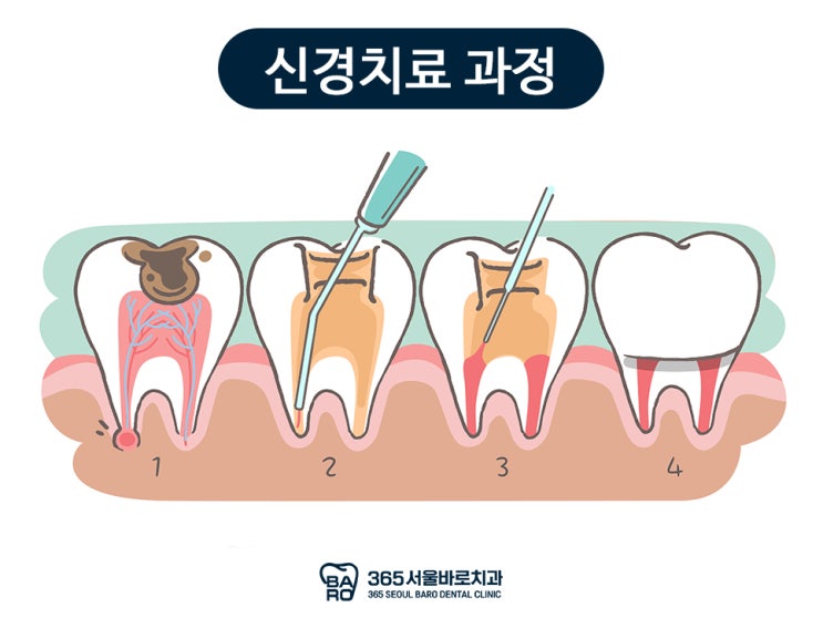  신경 치료 후 심한 통증이 발생한다면? 강동 근처치과
