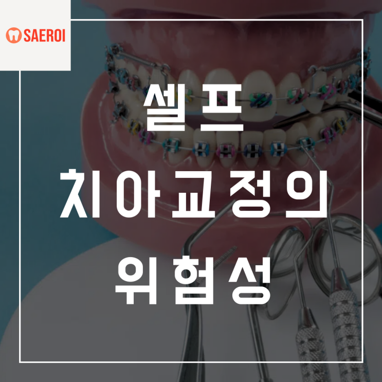  셀프치아교정의 위험성 / 교정장치를 중국에서 직구한다구요?