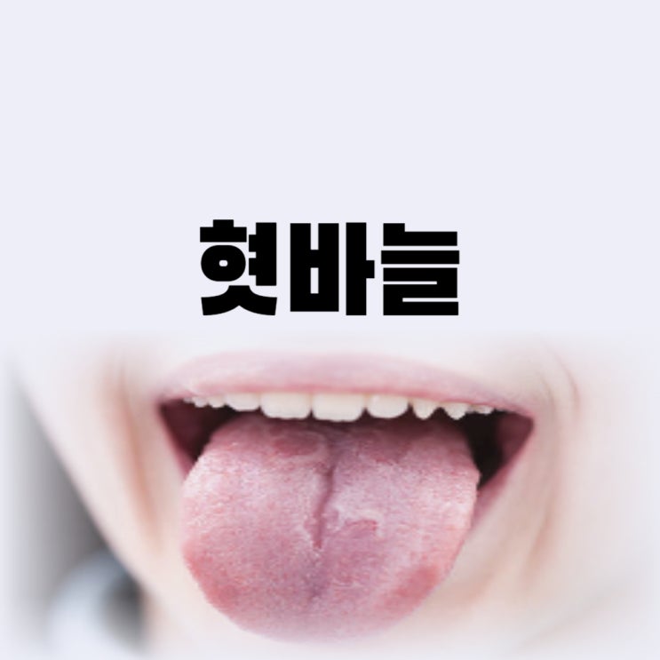  혓바늘빨리없애는법 어떤 약 치료를 해야 할까(알보칠)