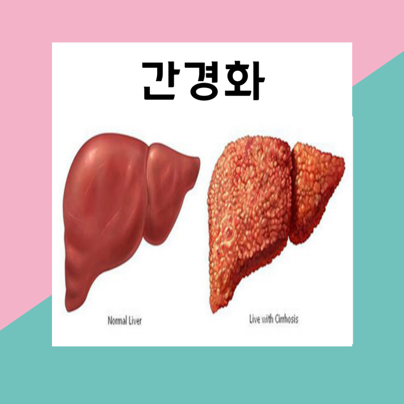간경화 초기증상 말기 치료법과 예방법