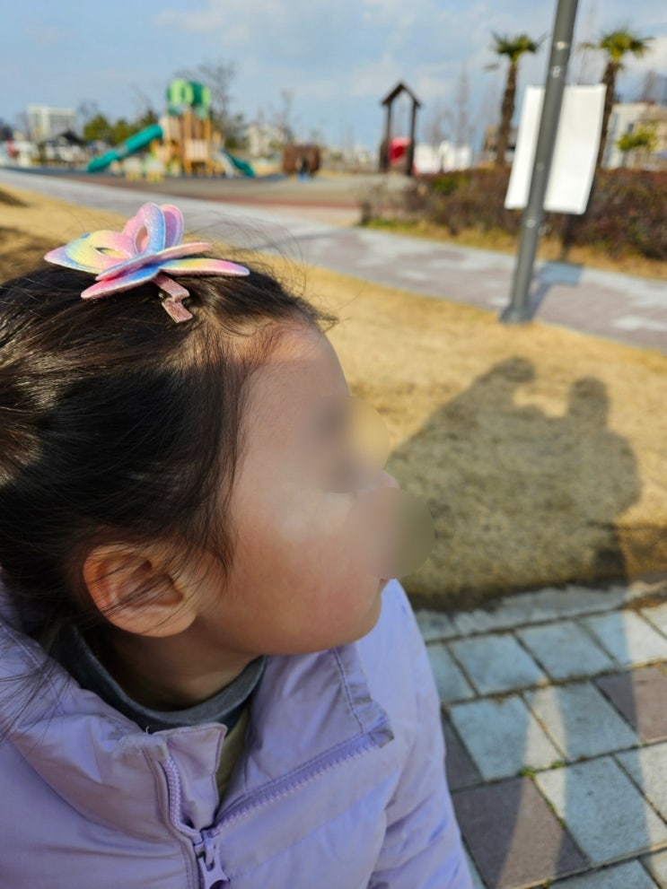  유아 하얀반점 아기 백색비강진과 백반증 차이