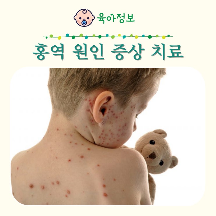 홍역 증상 예방접종 정의 증상 수두 차이점