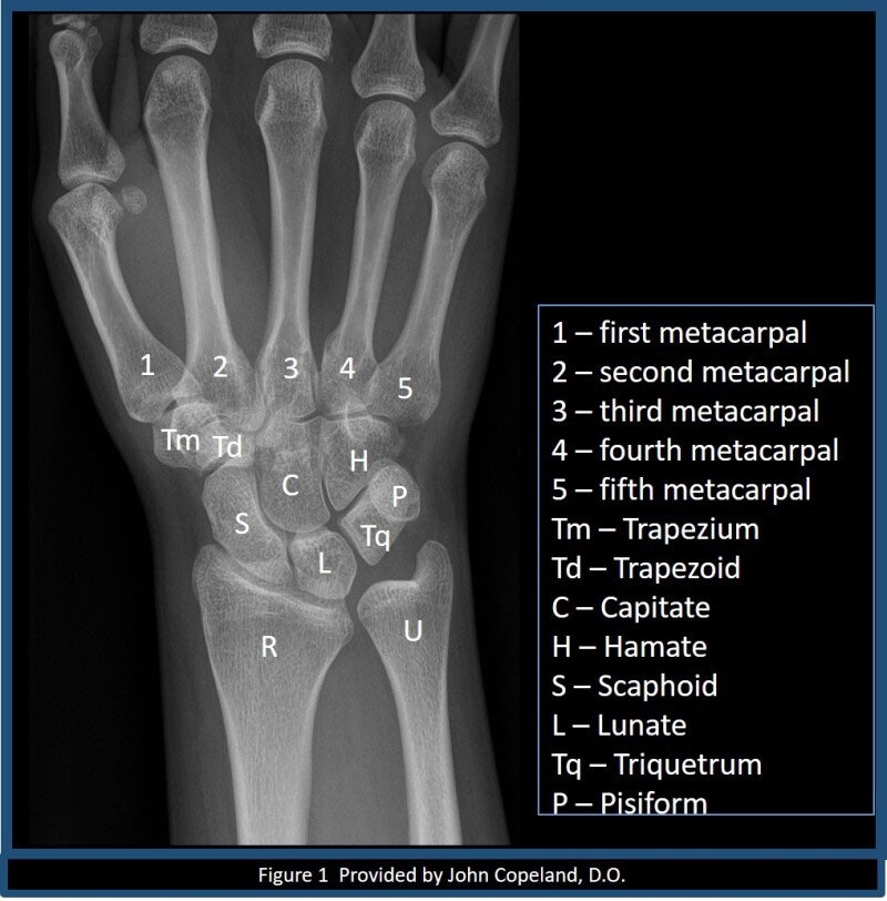 손목뼈 해부학(Wrist bone anatomy) : 네이버 블로그