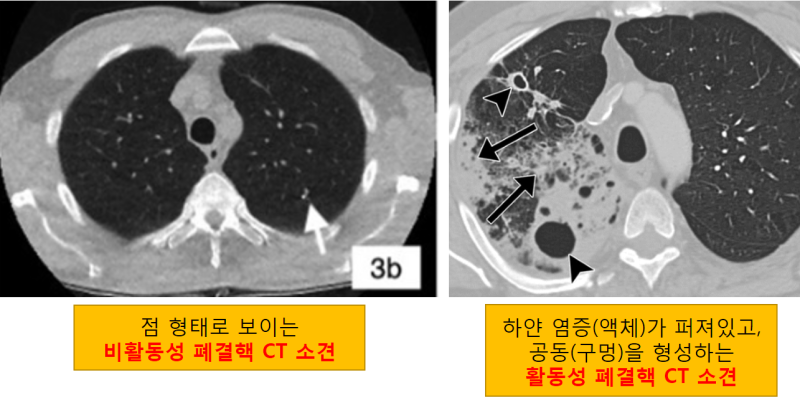 비활동성 폐결핵 의미와 치료 필요성 : 네이버 블로그