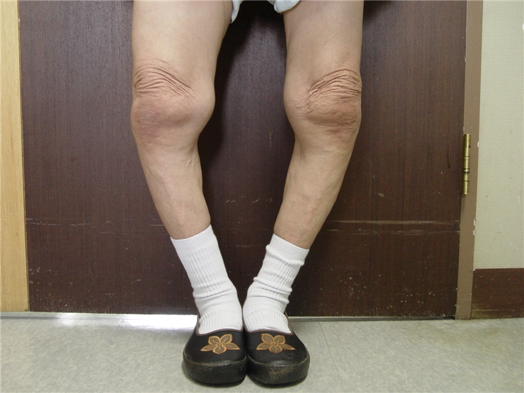  관절 영양제, 정형외과의사 엄마는 병원에서 처방받는다.  (의사작성)