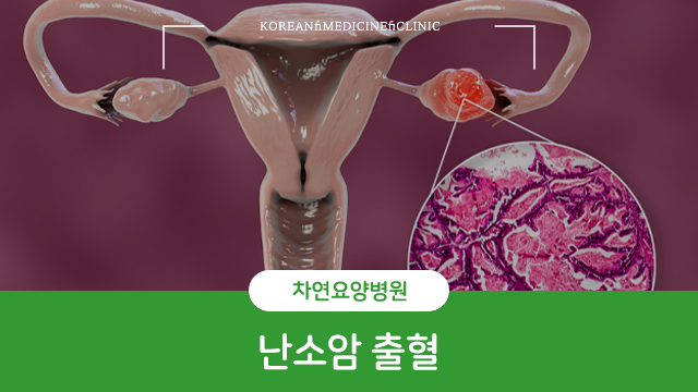  난소암 출혈 증상 있다면 바로 체크해야