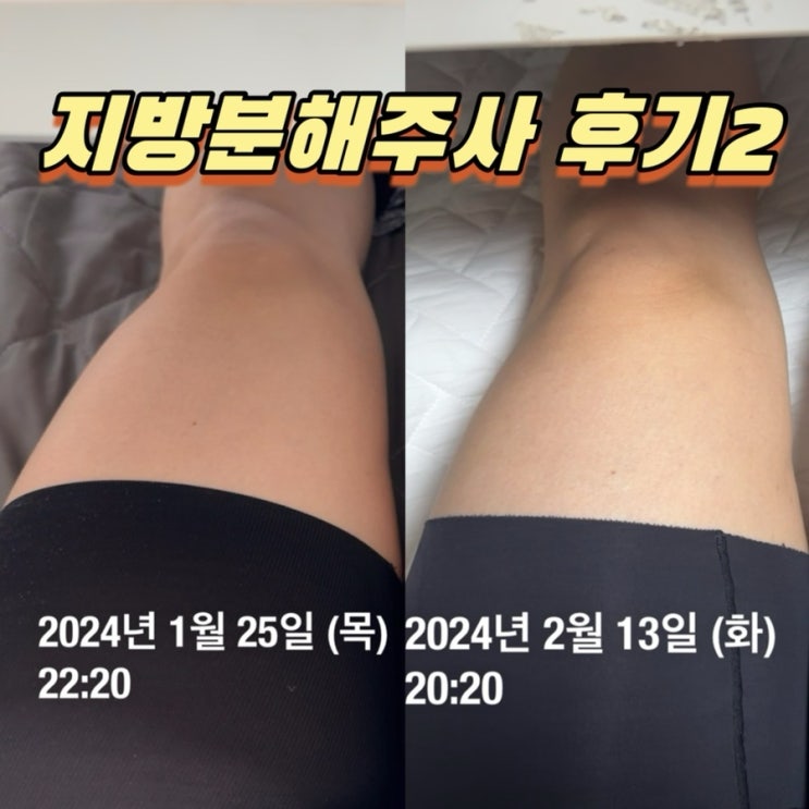  수원 다이어트병원 허벅지 지방분해주사 2회차
