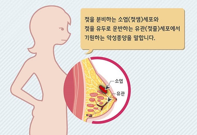  한국인에게 흔한 암 '유방암' 인포그래픽 (2024)