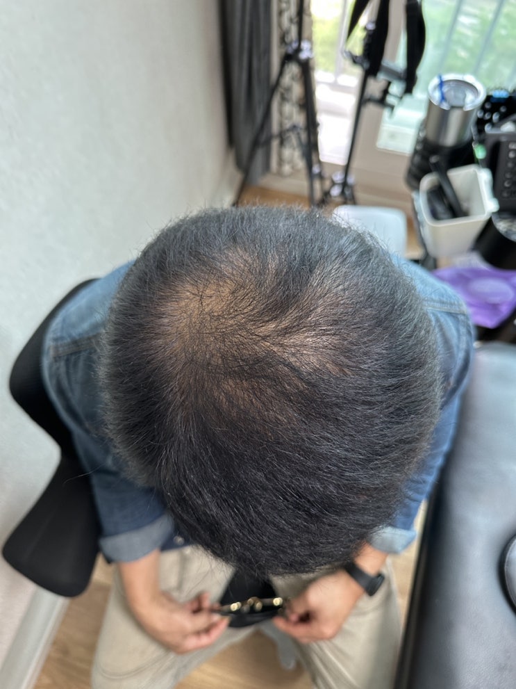  울산 원형탈모 남자 탈모 커버 업체 우두머리에서 해결될까?