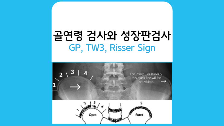 성장판 검사 병원-GP(Greulich Pyle),  TW3(Tanner, whitehouse 3), 리서사인(Risser Sign)