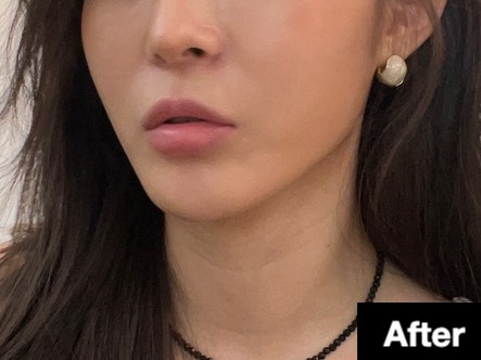  압구정역 피부과 ldm 물방울 인모드 리프팅 보정 없는 전후 사진 후기