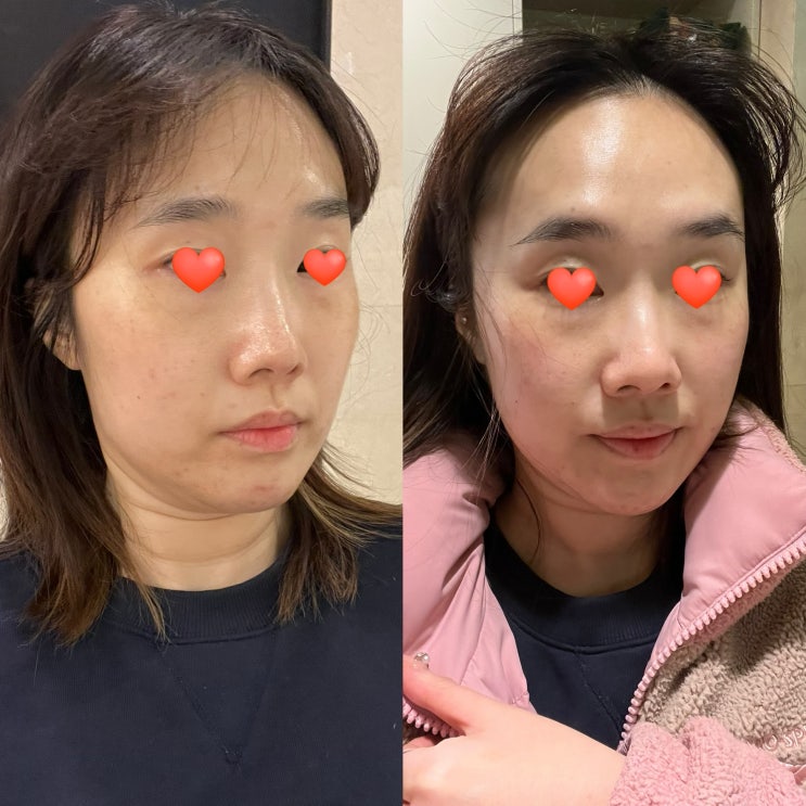  강남 에스테틱 작은얼굴관리 다시 태어난 얼굴형 후기