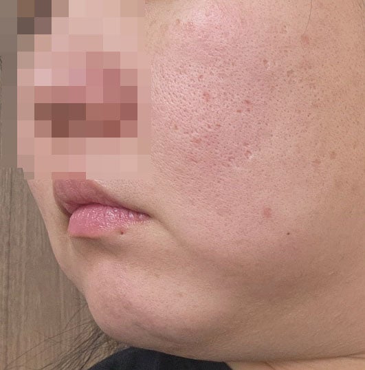  이중턱 윤곽주사보다 3배 강력한 마블주사 전후 사진 및 통증가격
