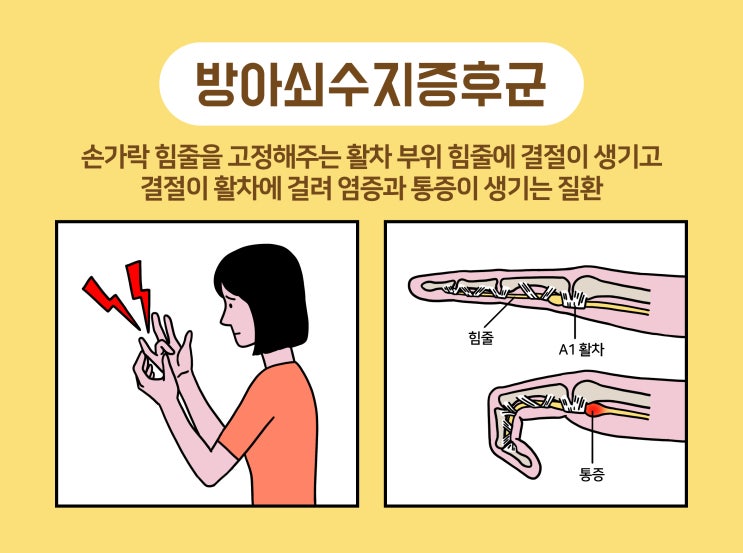  손가락이 안펴져요/ 방아쇠 수지 증후군 수술  (의사작성)