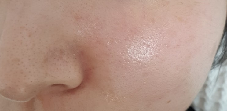  왕십리피부과 엑소좀 스킨부스터 후기