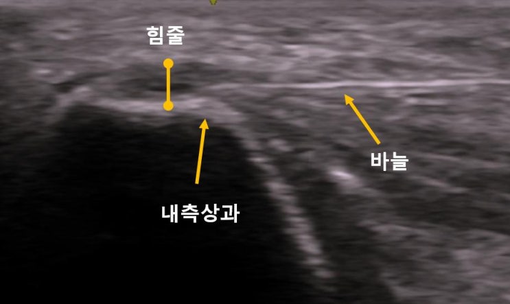  곡성정형외과, 골프엘보로 인대증식치료를 받으러 광주까지?
