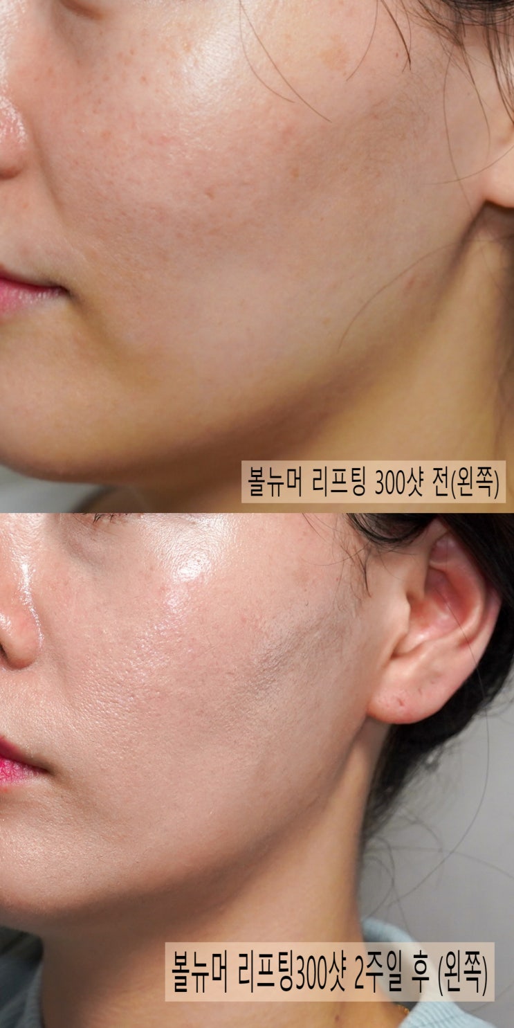 목동 피부 속 깊이 채워주는 볼뉴머리프팅 300샷 경과후기 및 부작용 목동 피부 속 깊이 채워주는 볼뉴머리프팅 300샷 경과후기 및 부작용