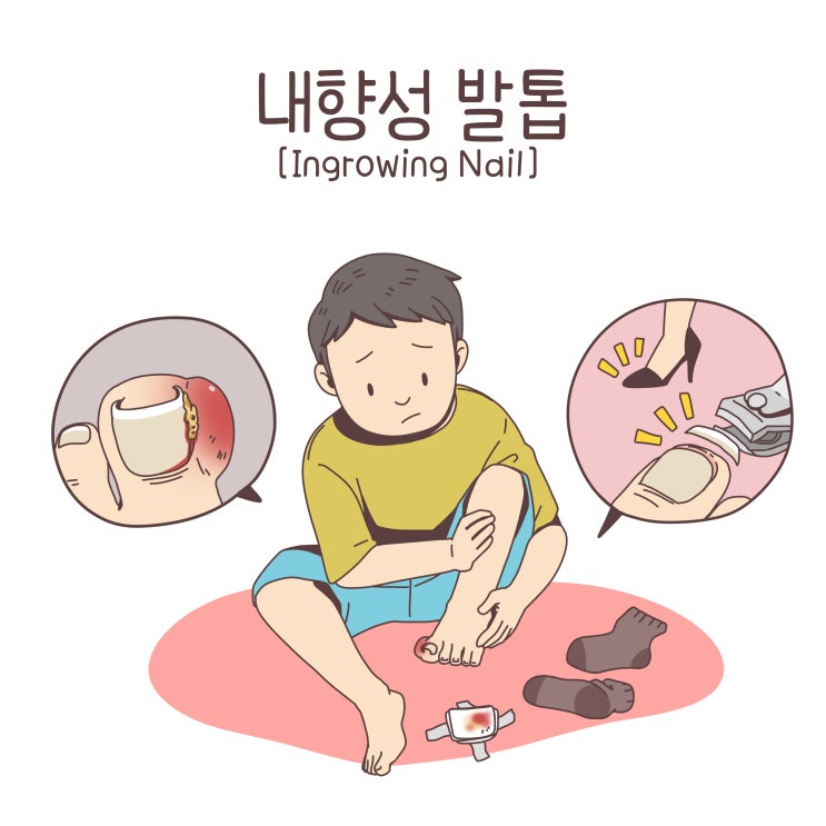  내성발톱 염증, 고름/ 내성발톱 수술 (의사작성)