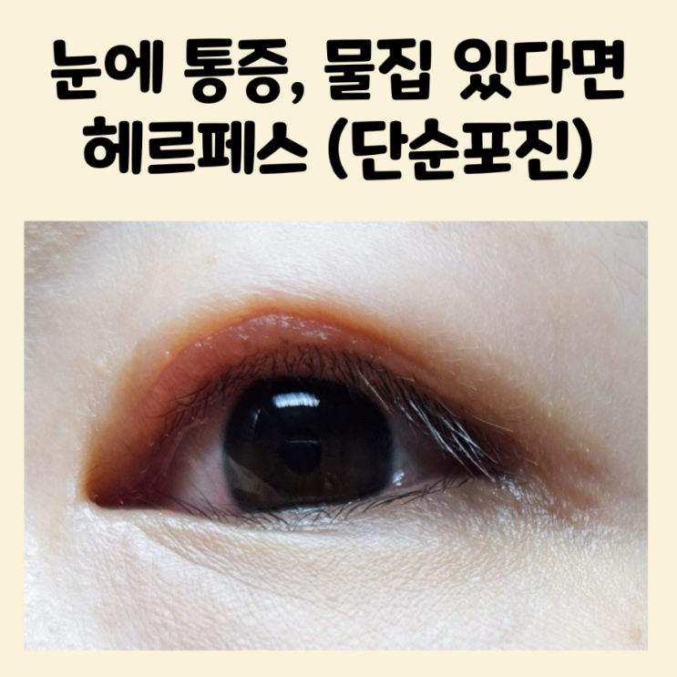 눈에 물집 생기고 통증 있다면 눈 헤르페스 단순포진 의심해야