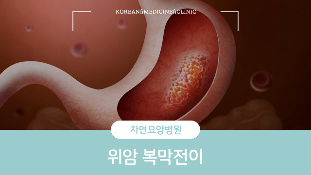  위암 복막전이 개선위해 면역 올려야