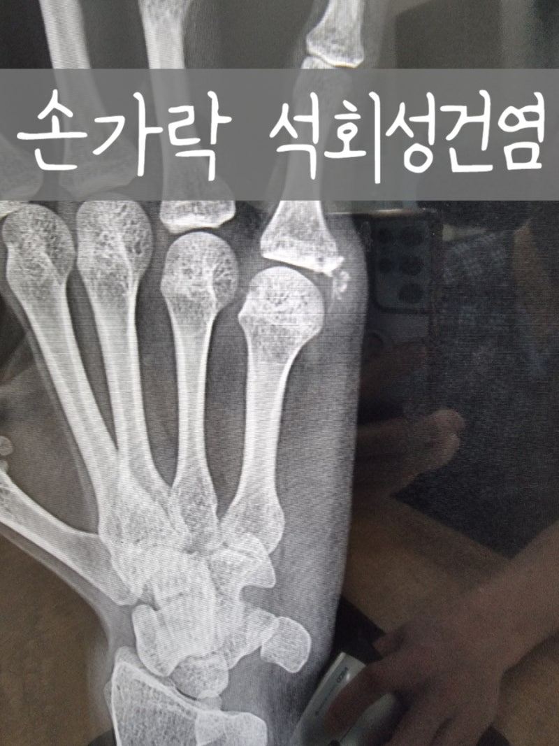 손가락 힘줄에 석회가 생기는 손가락석회성 건염