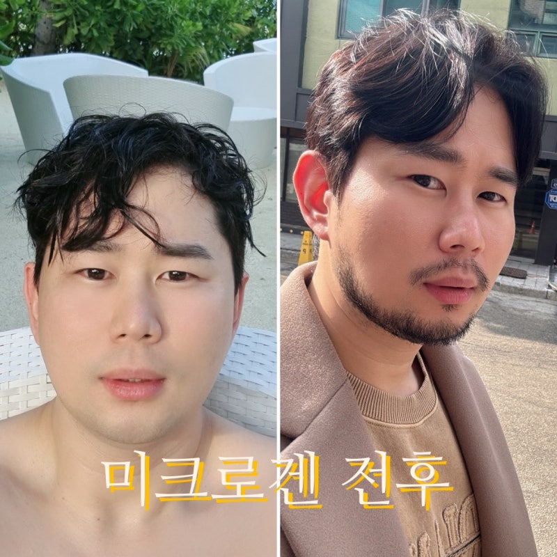일본 미크로겐 발모제 （파스타 &카페인）차이점