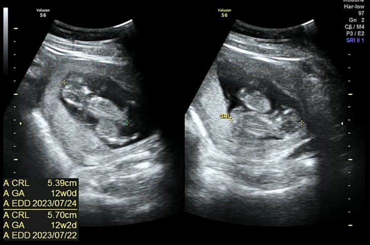 [임신12주] 12주차/대학병원/전원/단일양막/일란성쌍둥이/10만 분의 1의 확률로 찾아온 아기들...!