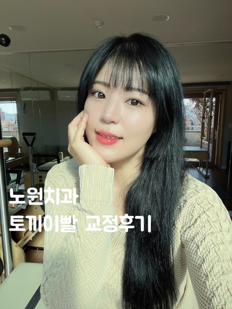  [노원치아교정] 노원치과 토끼이빨 초스피드 클리피씨 부분교정 2개월째 (벌써 뗀다고..?)