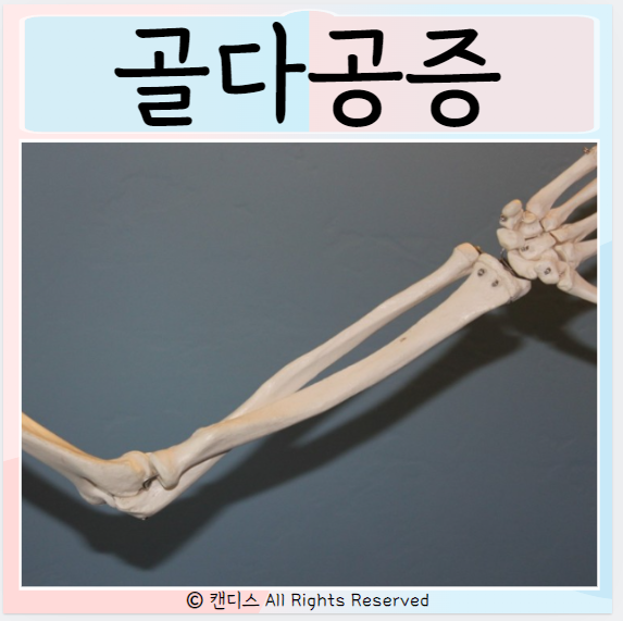  골다공증 원인 증상 진단방법 치료 예방 관리