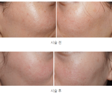 김포·검단신도시 미작뷰티 미백토닝 기미 제거, 예약방법, 가격, 주의사항 김포·검단신도시 미작뷰티 미백토닝 기미 제거, 예약방법, 가격, 주의사항