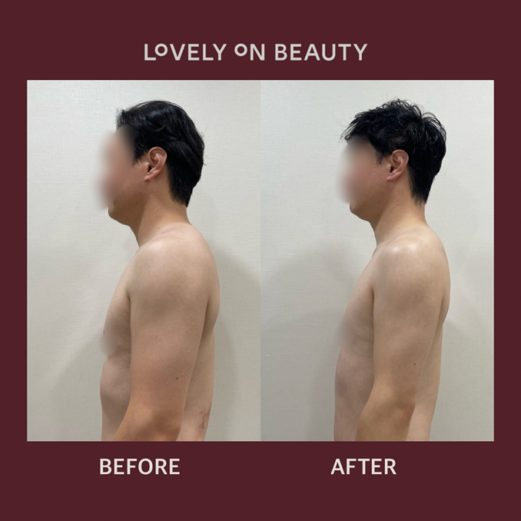 평거동 여드름, 피부가 좋아지기위해 등관리를 받아야 하는 이유?
