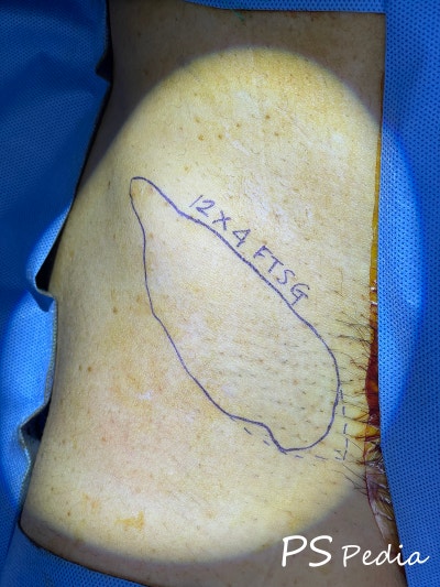 [피부이식] 전층 피부이식 수술 (FTSG, full thickness skin graft, 욕창치료 feat. 성형외과 전문의 ...