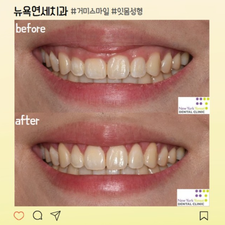 강남역 치과 | 짧은 치아, 잇몸 라인 성형으로 해결(후기, 효과, 비용)
