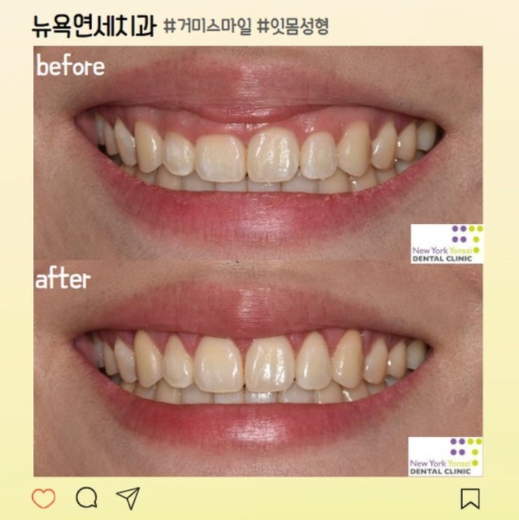  강남역 치과 | 짧은 치아, 잇몸 라인 성형으로 해결(후기, 효과, 비용)