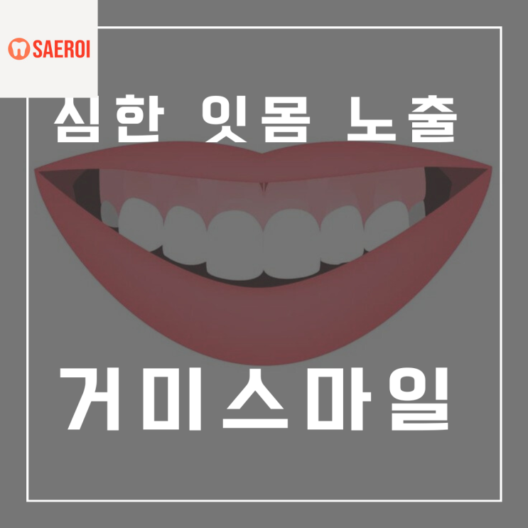  잇몸 노출이 심하다면, 치아교정으로 개선하세요(거미스마일)
