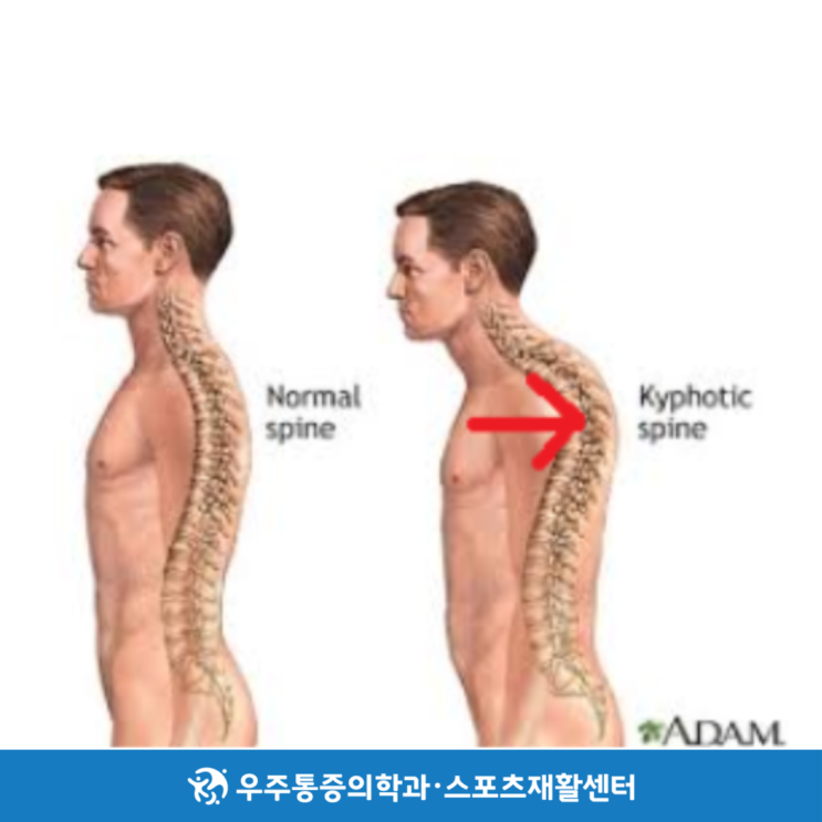  전주흉추후만, 잘못된 척추잡는 홈 스트레칭 2가지