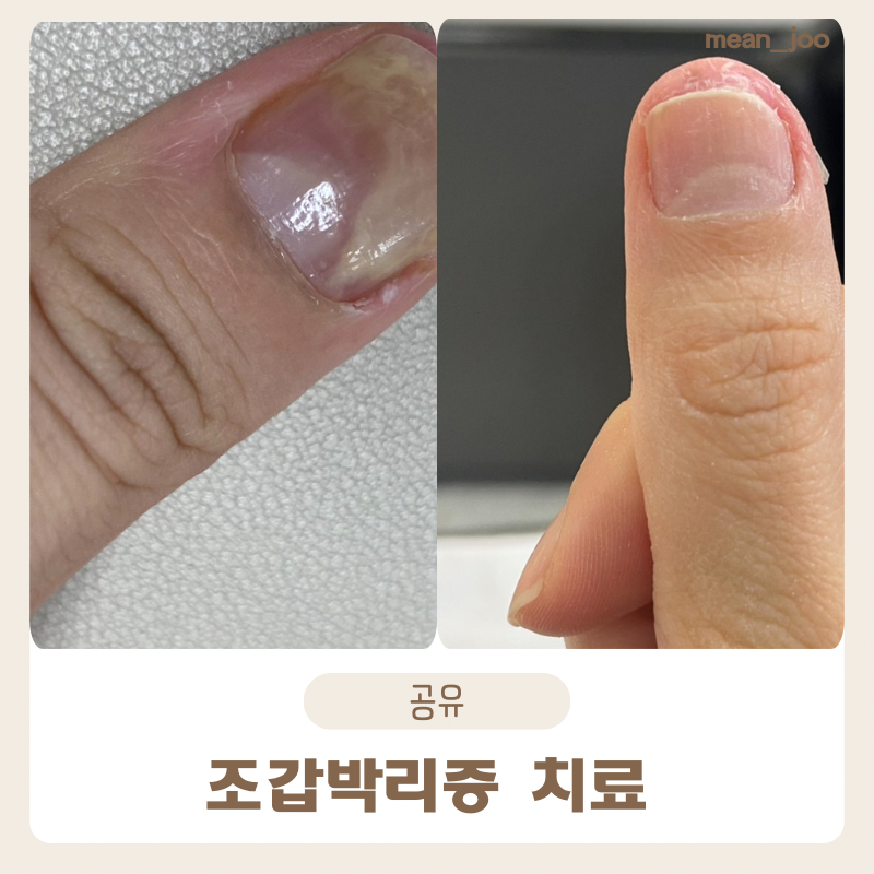 [조갑박리증] 실제 경험담을 통한 조갑박리증 치료 후기